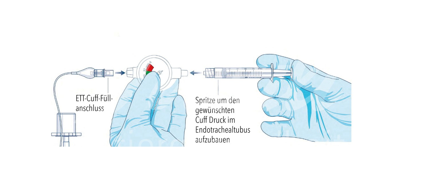 FV Manometer Druckmesser für PVC Trachealtuben 1 Stück